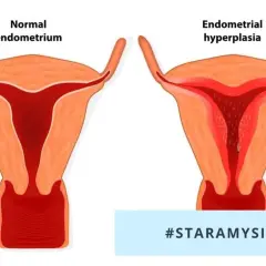 Porównanie prawidłowego endometrium z rozrostem gruczołowym błony śluzowej macicy.