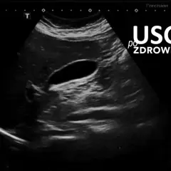 Obraz USG jamy brzusznej z widocznym pęcherzykiem żółtkowym.