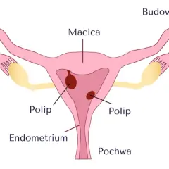 Schemat budowy macicy z widocznymi polipami w obrębie endometrium.