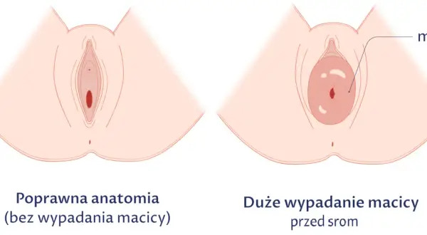 Obniżona macica po porodzie: 7 objawów, które musisz znać
