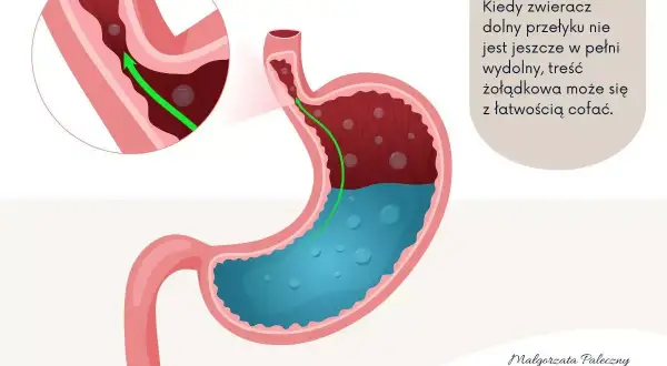 Ilustracja pokazuje cofanie się treści żołądkowej do przełyku, co jest przyczyną refluksu u dzieci. Zielona strzałka wskazuje cofanie się.