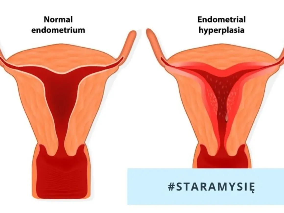 Porównanie prawidłowego endometrium z rozrostem gruczołowym błony śluzowej macicy.