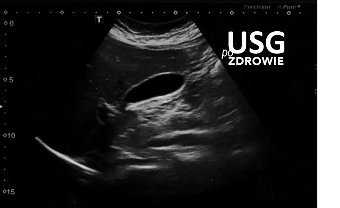 Obraz USG jamy brzusznej z widocznym pęcherzykiem żółtkowym.