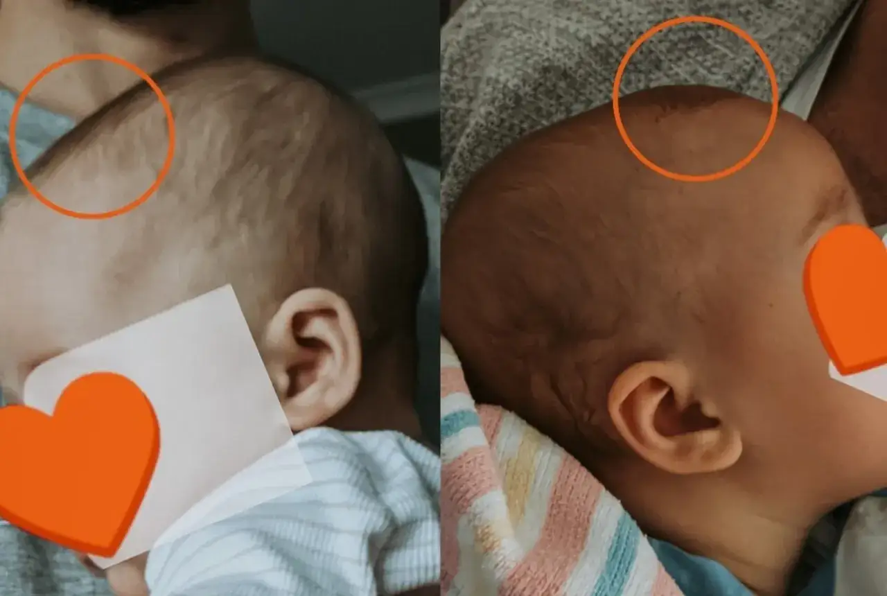Dwa ujęcia główki niemowlaka. Na pierwszym widać wyraźne ciemiączko przednie, na drugim jest ono mniej widoczne.